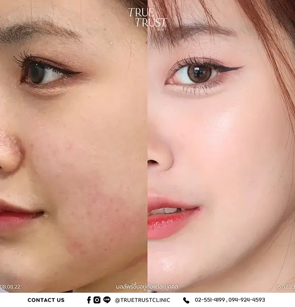 Review_skin-filter-set_3